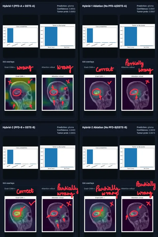 Grad-CAM++ and Attention Rollout comparison for a challenging glioma across all four model variants.