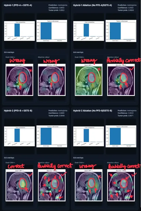 Grad-CAM++ and Attention Rollout comparison for a pituitary MRI misclassified as meningioma by every model.